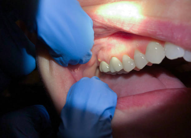 Best Emergency Denture Repair in Seabrook Farms, NJ